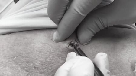 Dr. Lee entfernt einen RIESIGEN Mitesser – Dr. Sandra Lee, Hautärztin – Discovery HH_1080p